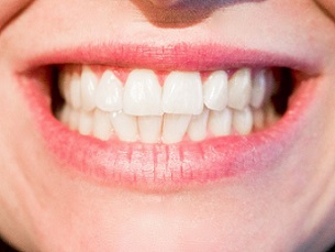 Implant dentaire beau sourire smallsize