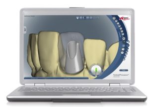 Implant dentaire ordinateur