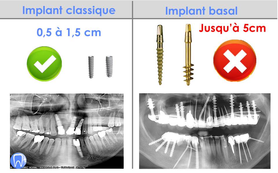 Comparaison implant classique et implant basal