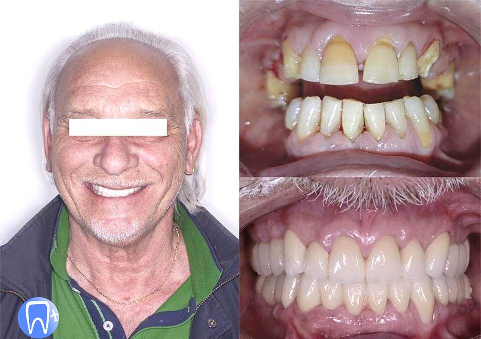 avant après implant dentaire