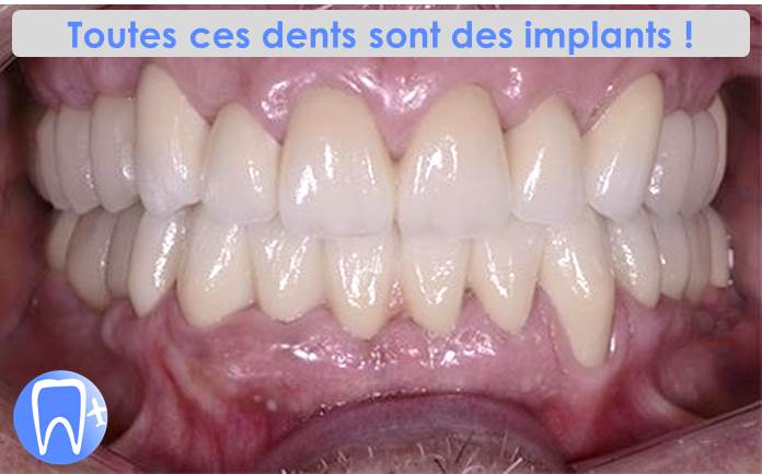 toutes ces dents sont des implants