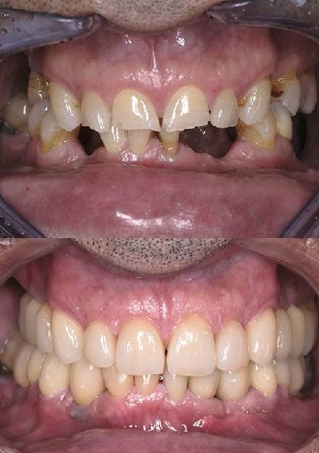 Avant Après - Homme - Implant dentaire, Bridges Zircone et couronnes Céramique