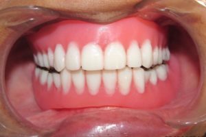 dentier amovible