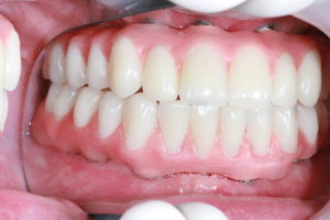 dentier sur implants haut et bas