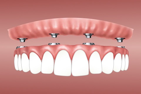 dentier fixe sur implant dentaire