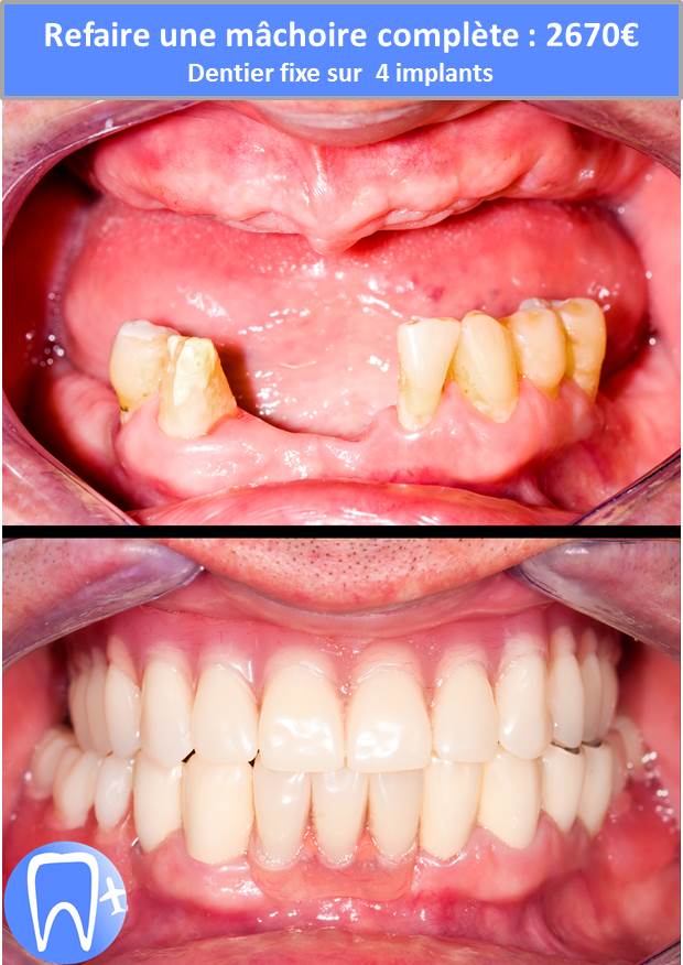 Refaire une mâchoire complète avec dentier sur implant dentaire