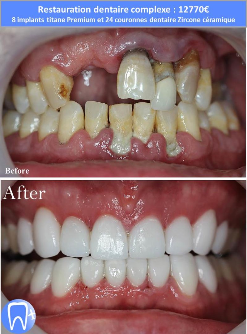 Refaire ses dents pas cher Devis avec tarifs et photos avantaprès Refaire ses dents pas cher Devis avec tarifs et photos avantaprès