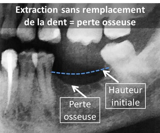 Perte osseuse après extraction dentaire