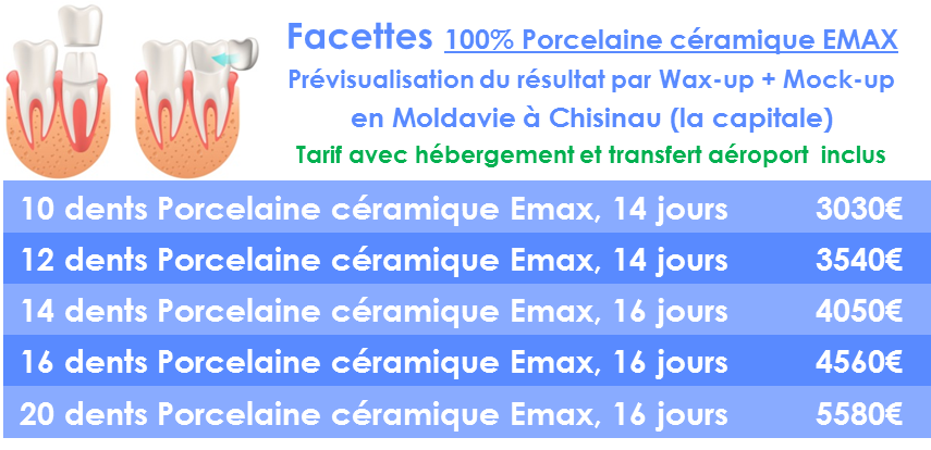 Prix Facette dentaire céramique en Moldavie