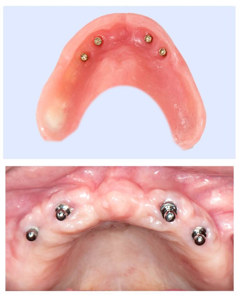 Appareil Dentaire Clipse Sur Implant Prix En France