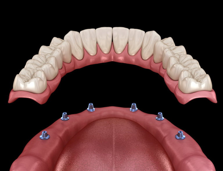 Appareil Dentaire Clipsé Sur Implant Prix En France