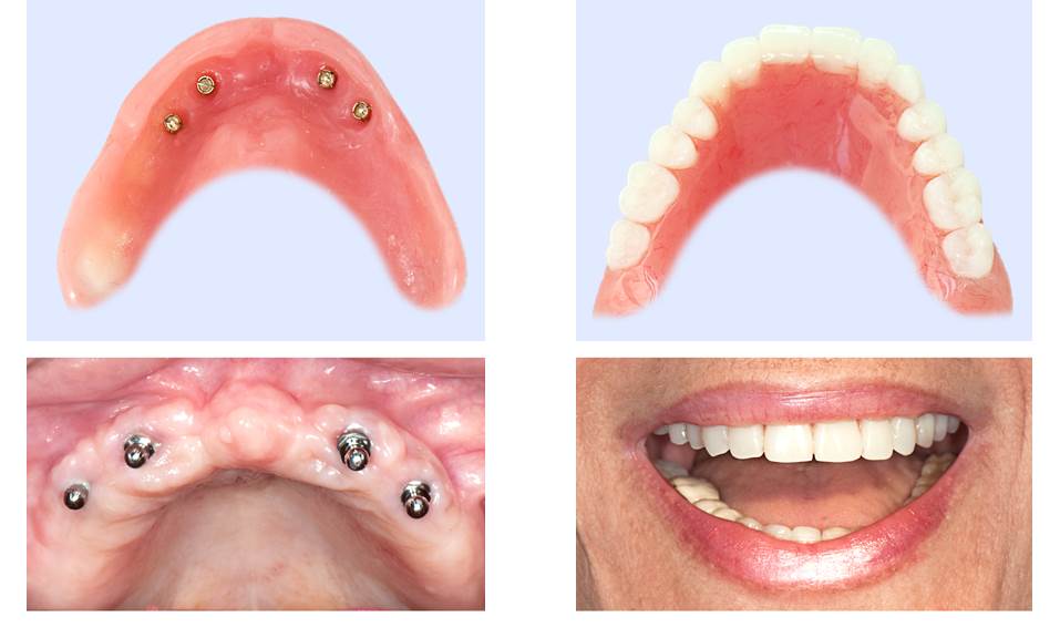 refaire toutes ses dents en une seule fois avec dentier fixe sur implant