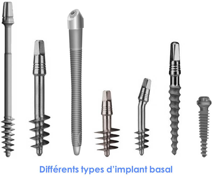 Différents types d'implant basal