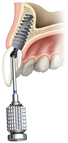 Implant dentaire avec couronne vissée