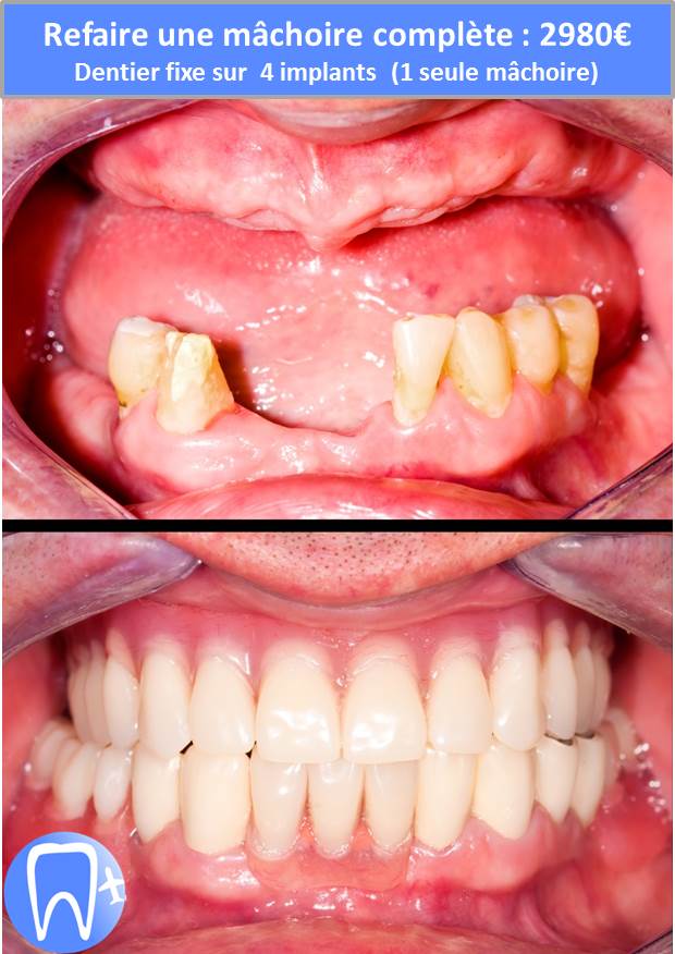 Refaire une mâchoire complète avec dentier sur implant dentaire