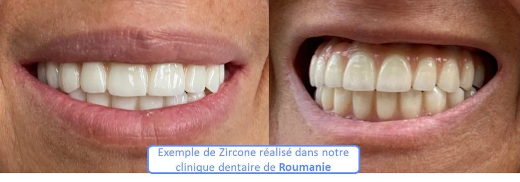 Matériau pour refaire ses dents : Zircone