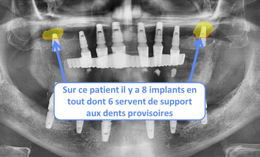greffe osseuse et prothèse dentaire immédiate sur implant