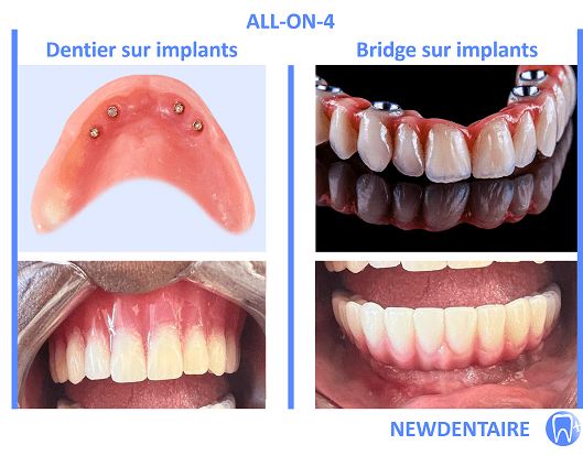 All-on-4 Dentier Vs Bridge