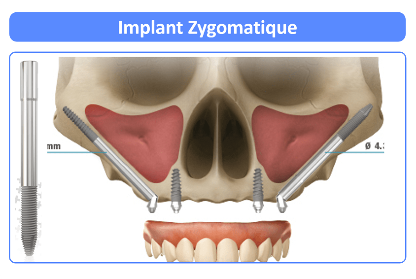All-on-4 Implant zygomatique