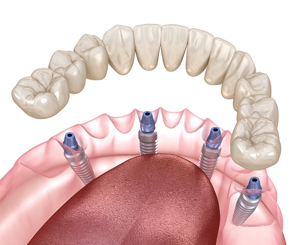 Matériau pour refaire ses dents - Bridge sur implant