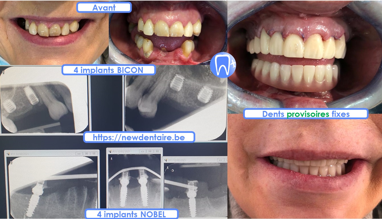 Allon4 sur implant dentaire Nobel et dents provisoires fixes