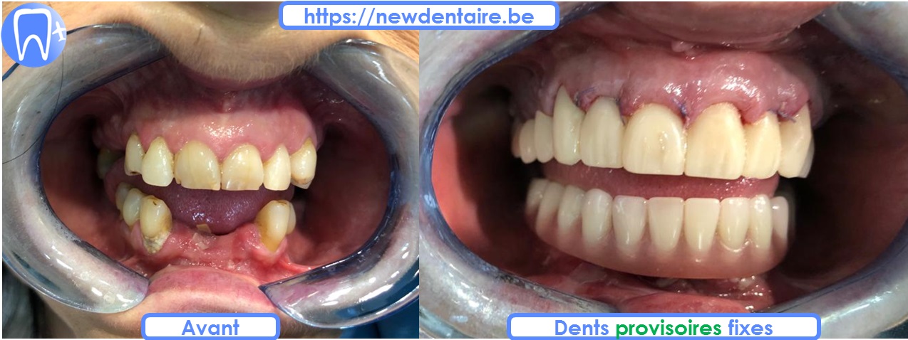 Allon4 sur implant dentaire Nobel