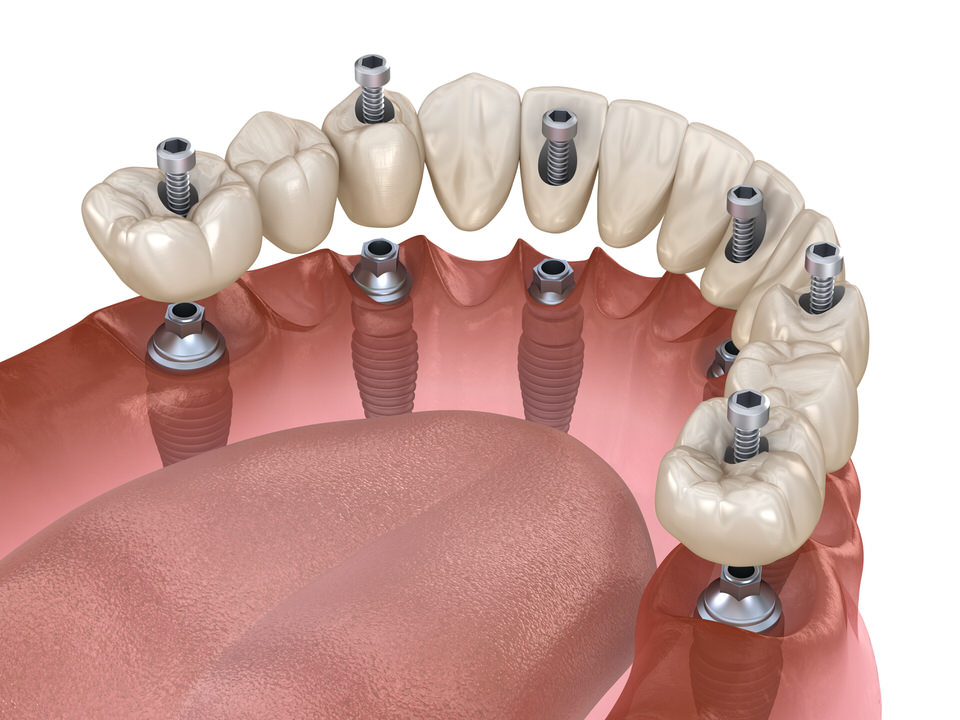 Bridge transvissé pour entretien des implants implants dentaires