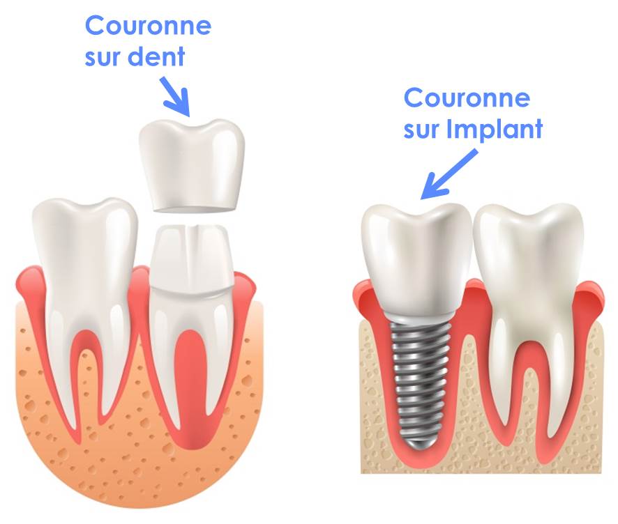 Couronne dentaire sur dent et sur implant dentaire