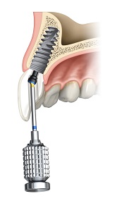 Couronne dentaire vissée sur implant