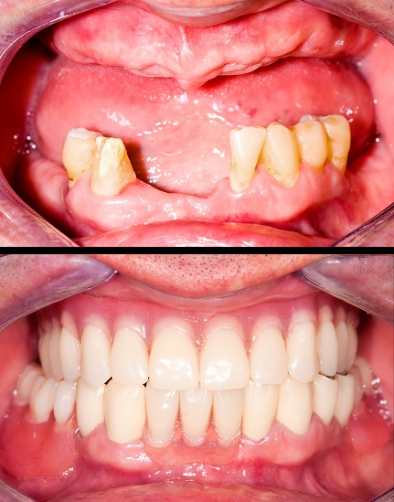 Dentier fixe sur implants avant-après