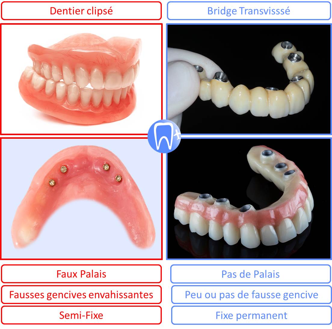 Dentition complète fixe avec bridge ou dentier