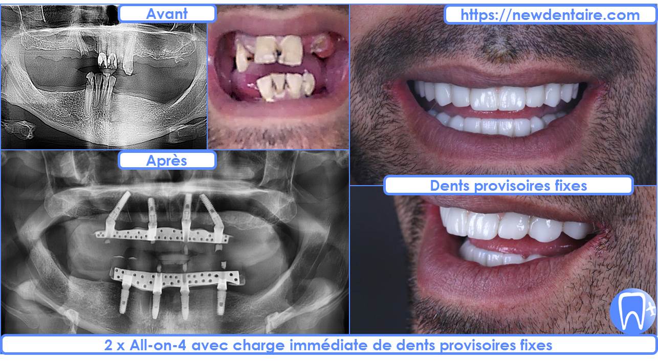 Dentition complete implant dentaire - Newdentaire
