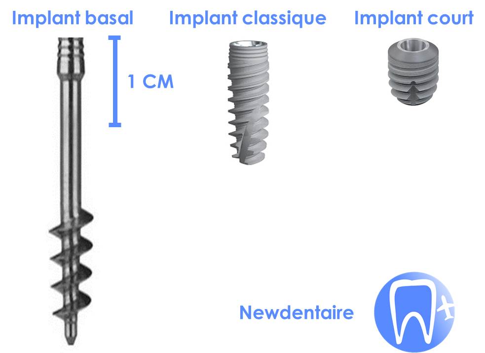 Différence implant basal et classique
