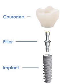 Etapes tourisme dentaire implant pilier couronne