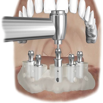 Guide chirurgical pour implant dentaire