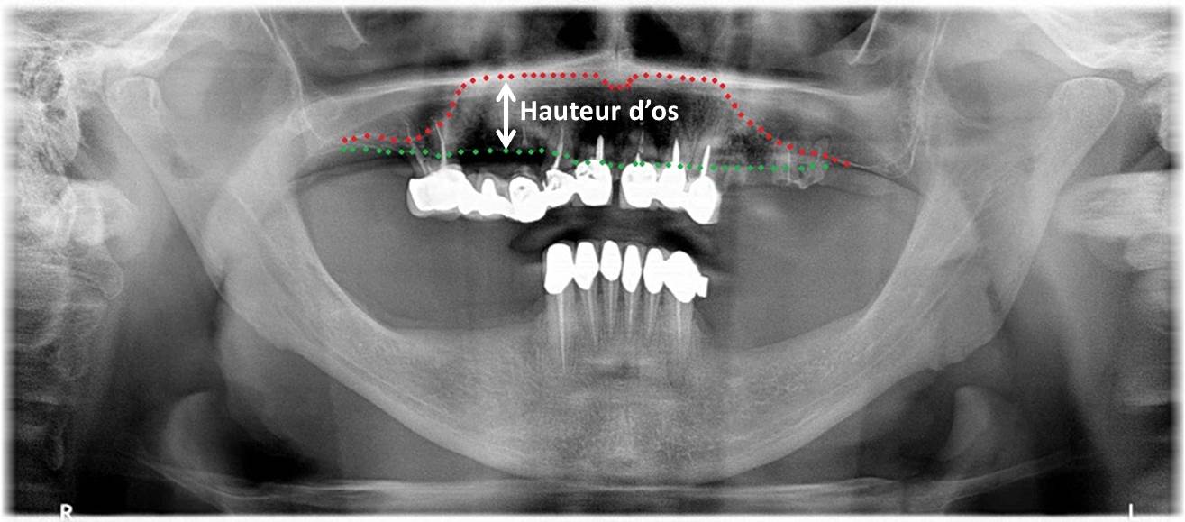 Hauteur d'os disponible pour implant dentaire