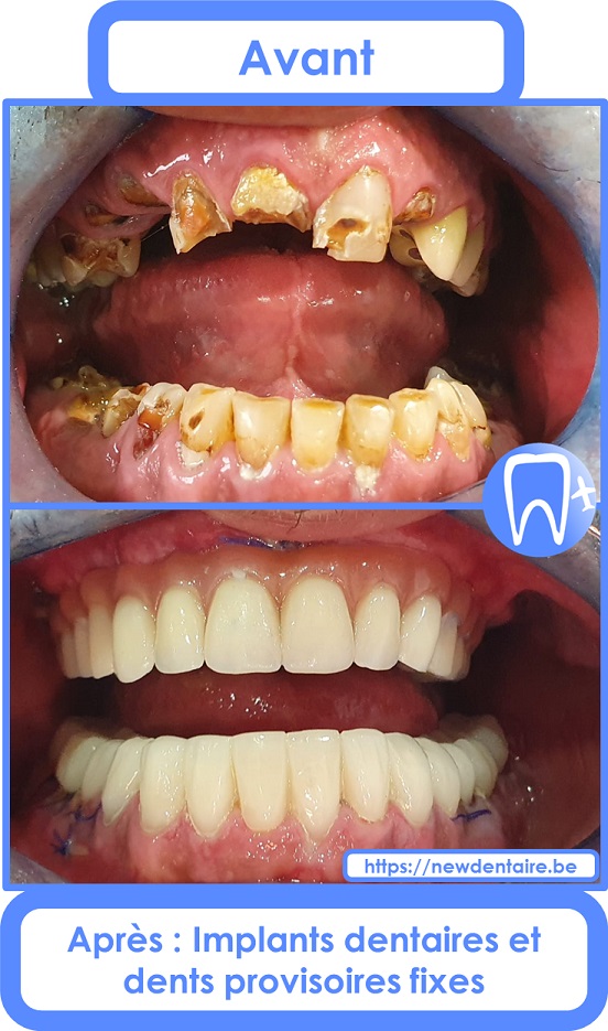 Implant dentaire All-on-6 Nobel Biocare avec dents provisoires fixes