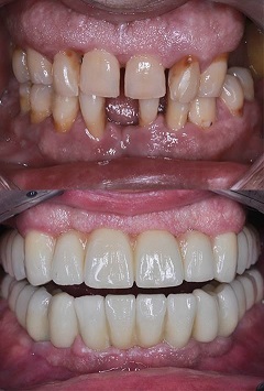 Implant dentaire bridge couronnes esthétique avant et après