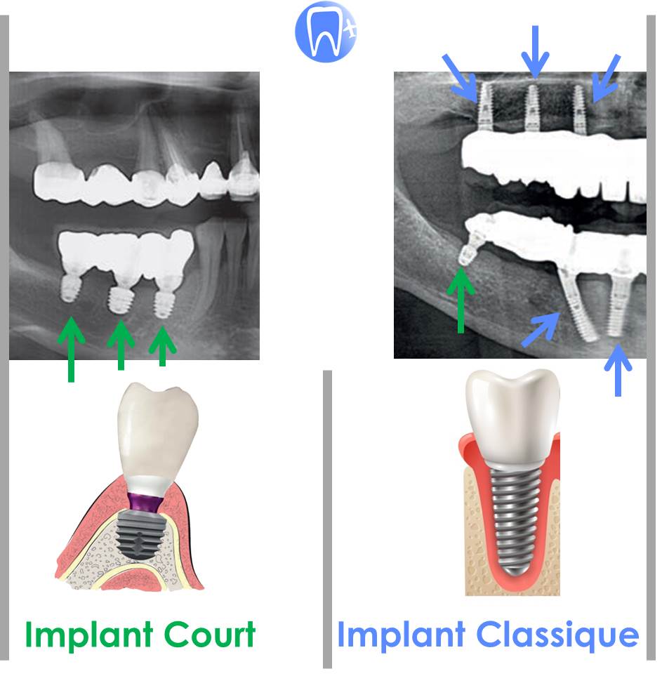 Implant dentaire court Vs classique
