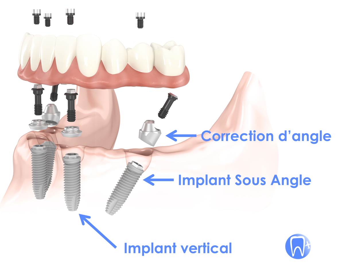Implant dentaire sous angle
