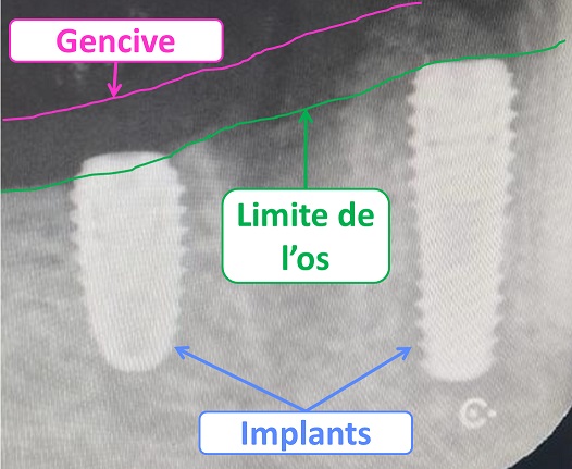 Implant sous la gencive - Sans charge immédiate