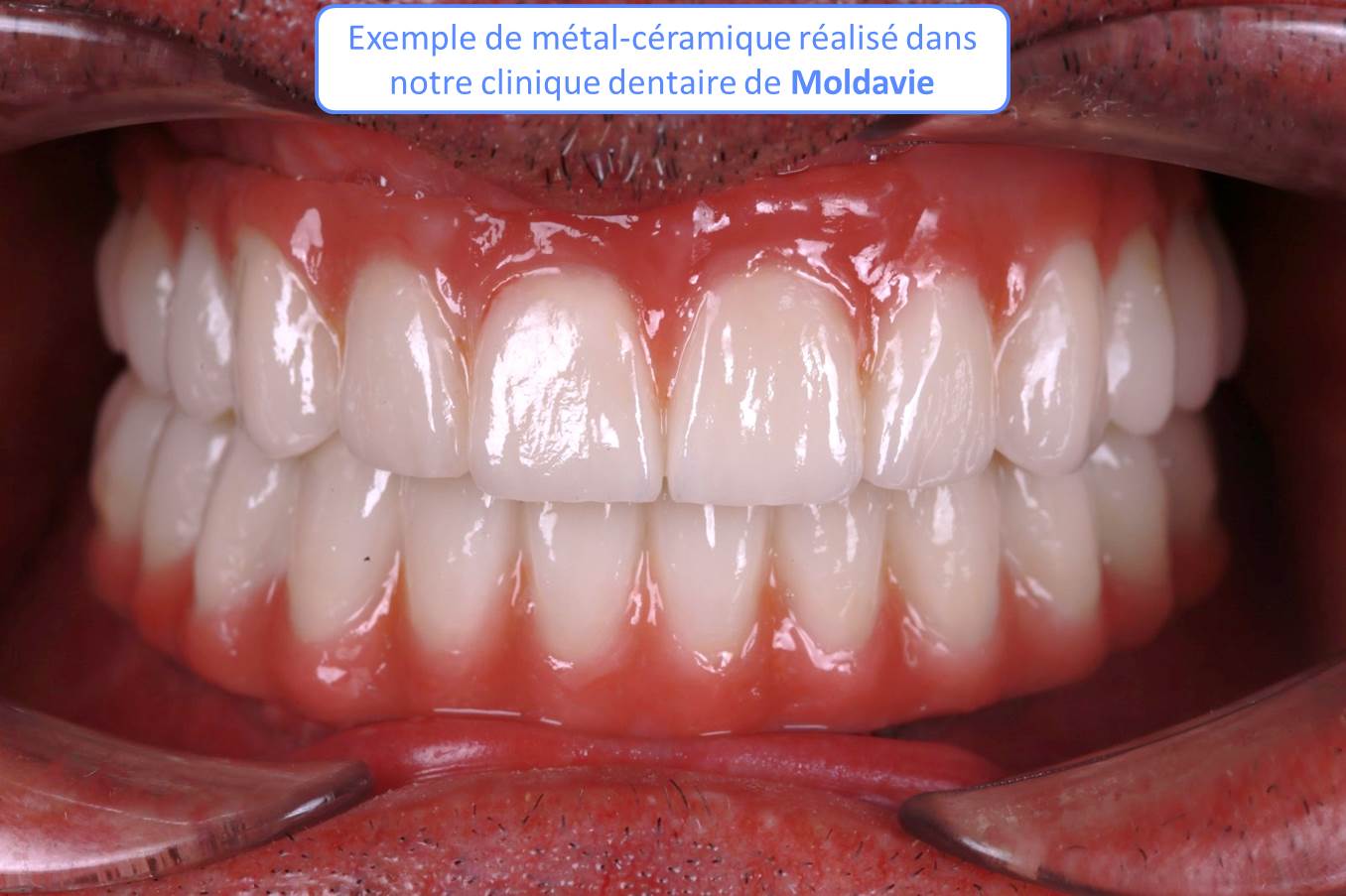 Matériau pour refaire ses dents : métal-céramique