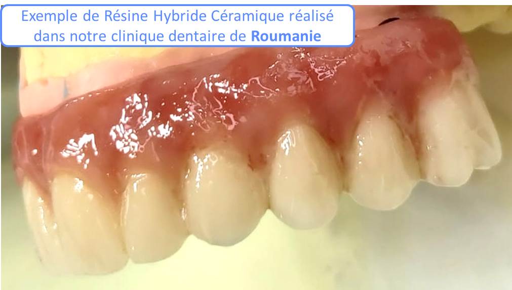Matériau pour refaire ses dents : Résine Hybride Céramique
