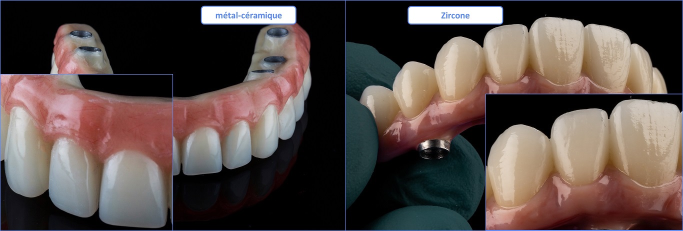 Zircone Vs Métal-céramique pour refaire ses dents