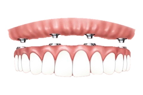Prothèse dentaire fixe sur implant