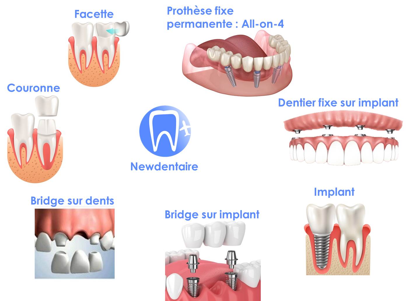 Types de prothèses dentaires fixes