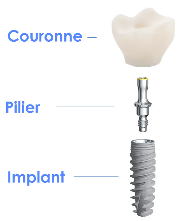 Prix des soins dentaires à l'étranger couronne pilier implant