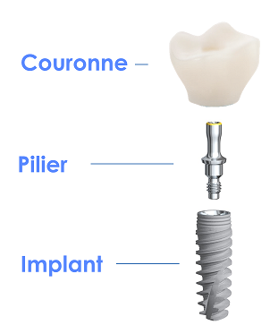 couronne-pilier-implant dentaire
