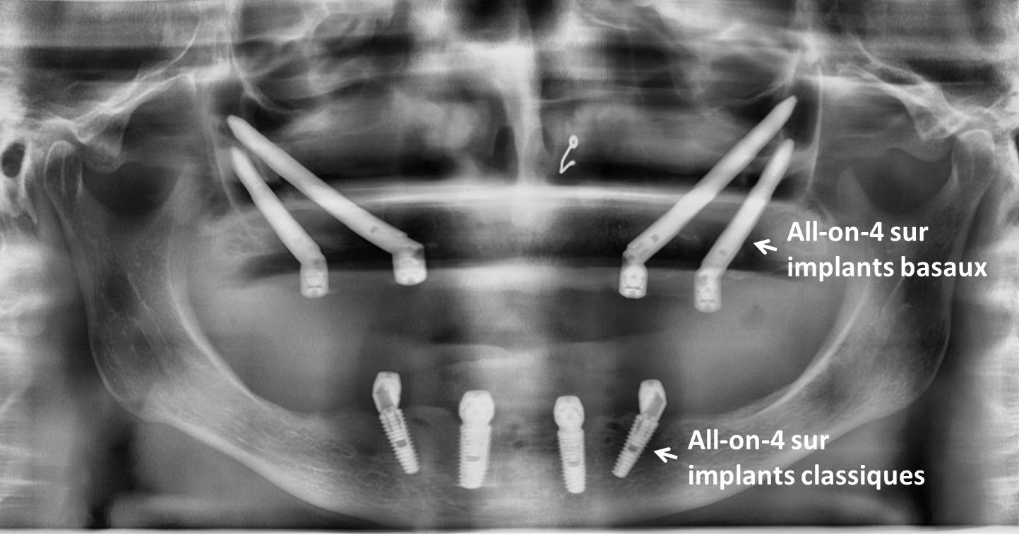 implant basal sur radiographie panoramique dentaire