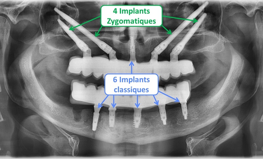 implant zygomatique